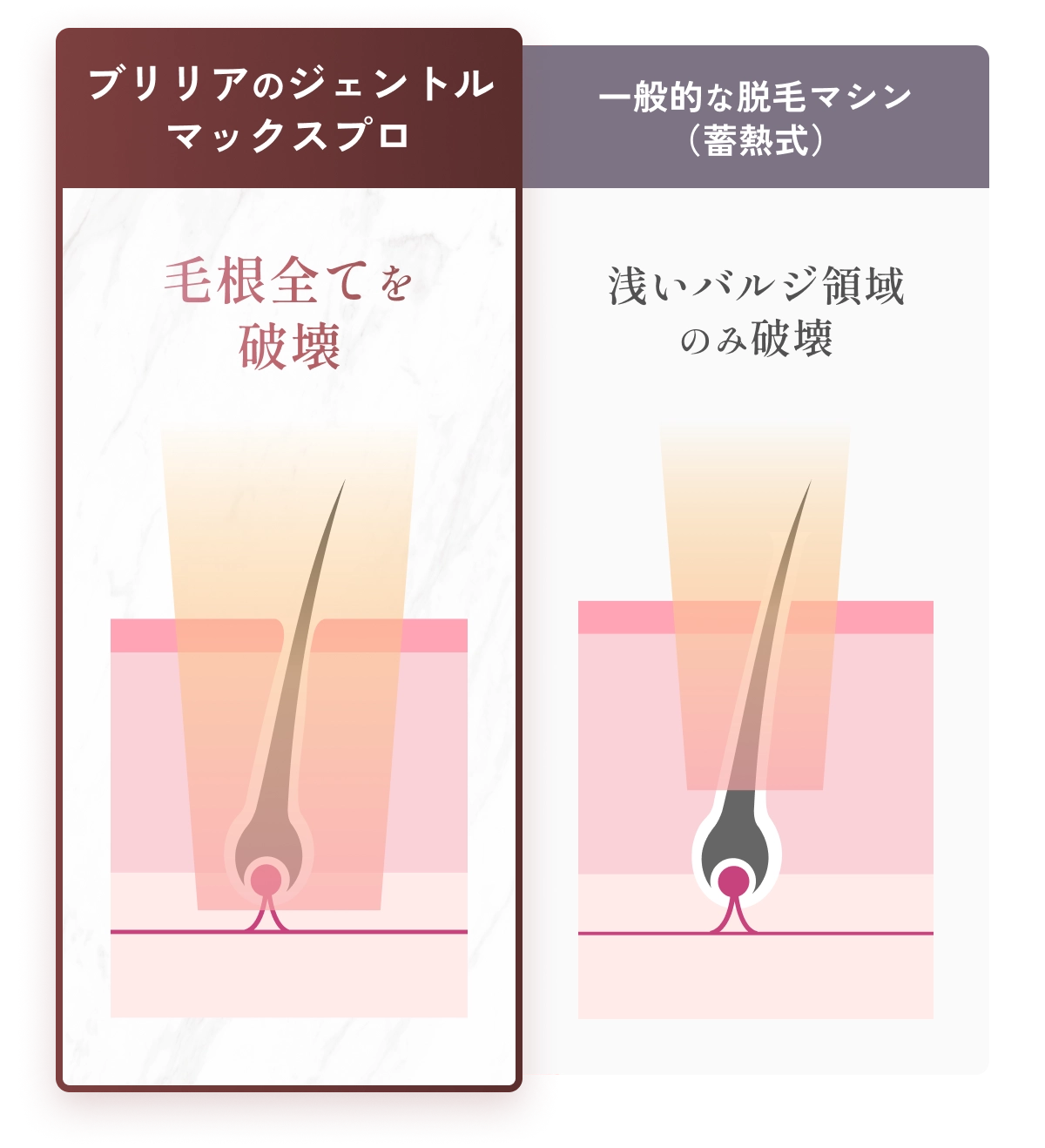 ブリリアのジェントルマックスプロは毛根全てを破壊。一般的な脱毛マシン（蓄熱式）は浅いバルジ領域のみ破壊