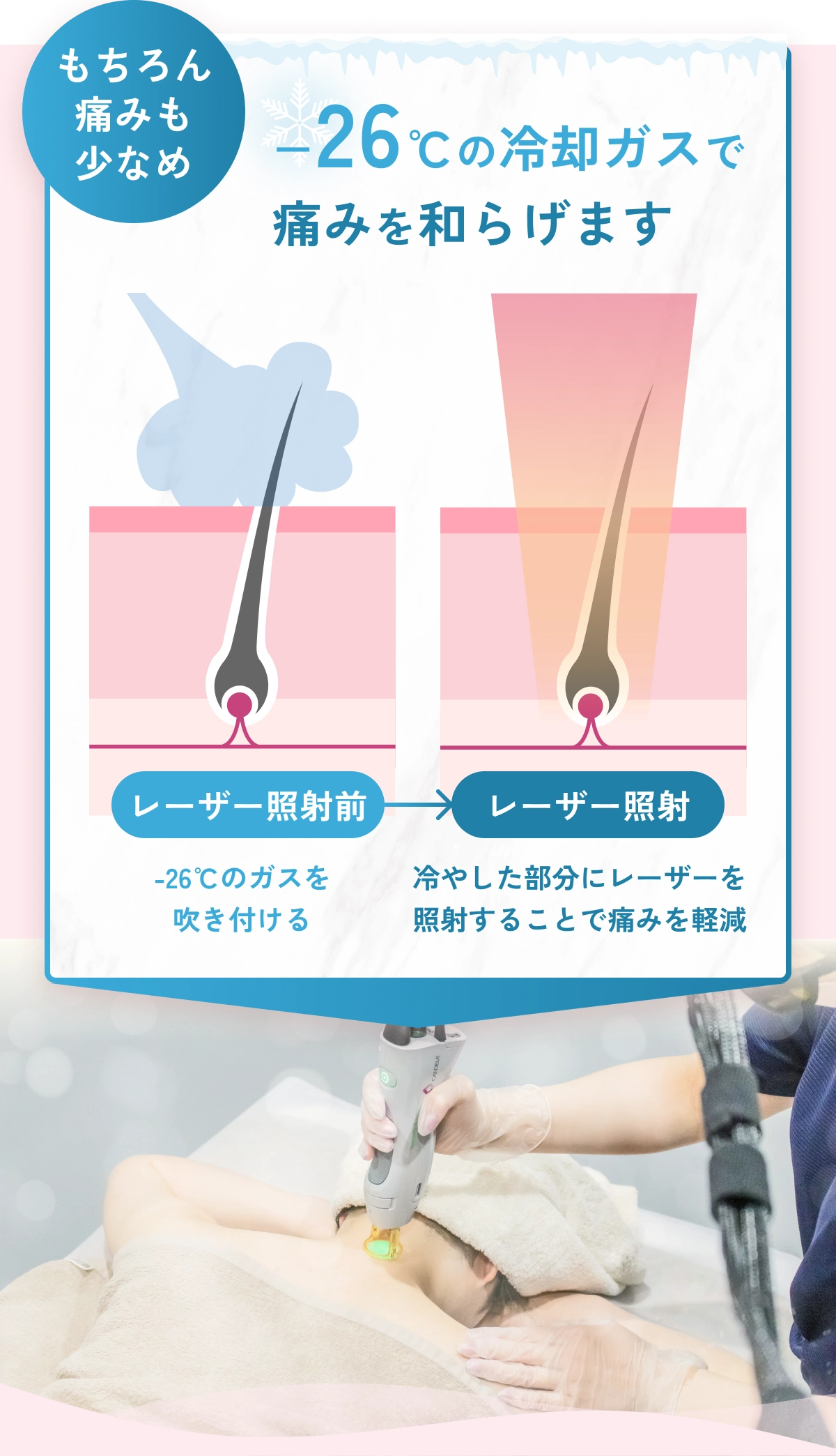もちろん痛みも少なめ。−26℃の冷却ガスで痛みを和らげます。レーザー照射前に-26℃のガスを吹き付け、冷やした部分にレーザーを照射することで痛みを軽減
