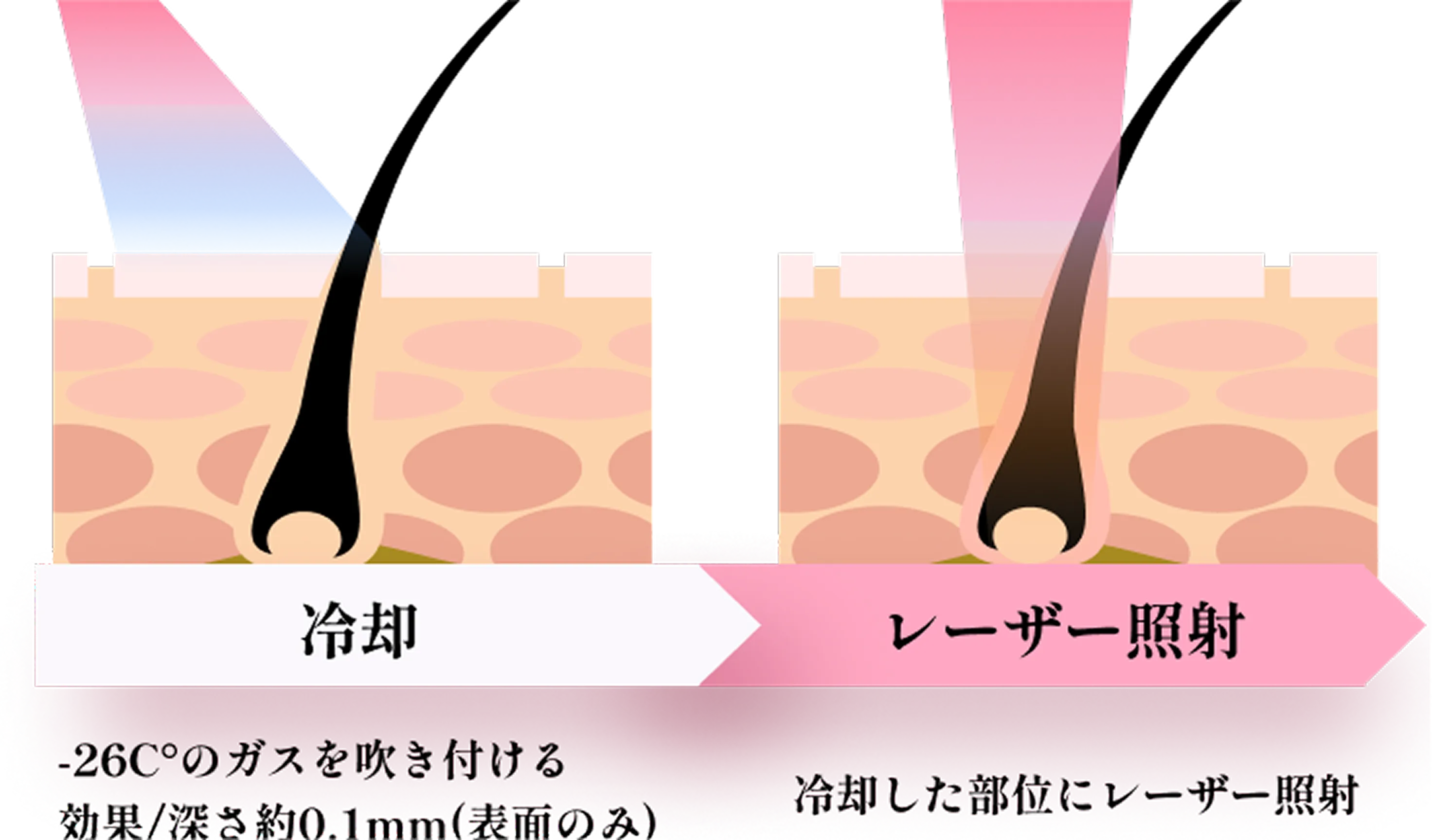冷却 レーザー照射
