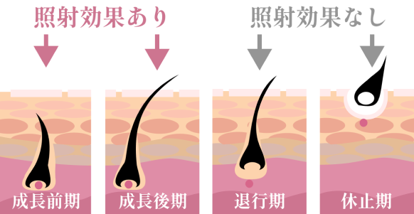 毛周期に合わせたベストな脱毛感覚 毛周期は「成長期」→「退行期」→「休止期」の三段階で生え変わります。最も脱毛効果の高い「成長期の毛」に合わせて1~2ヶ月周期で照射します