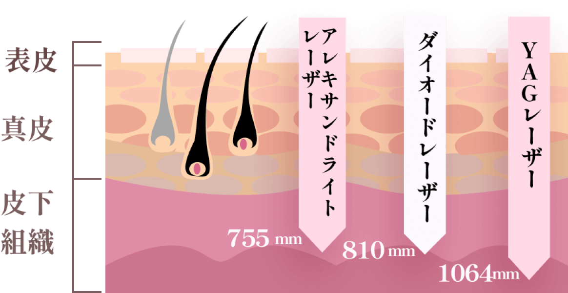 お客様の肌質・毛質に合わせたレーザーで施術 脱毛器だけでなく、施術もお客様の肌質・毛質に対応したレーザーや照射タイミングで施術を行います。
