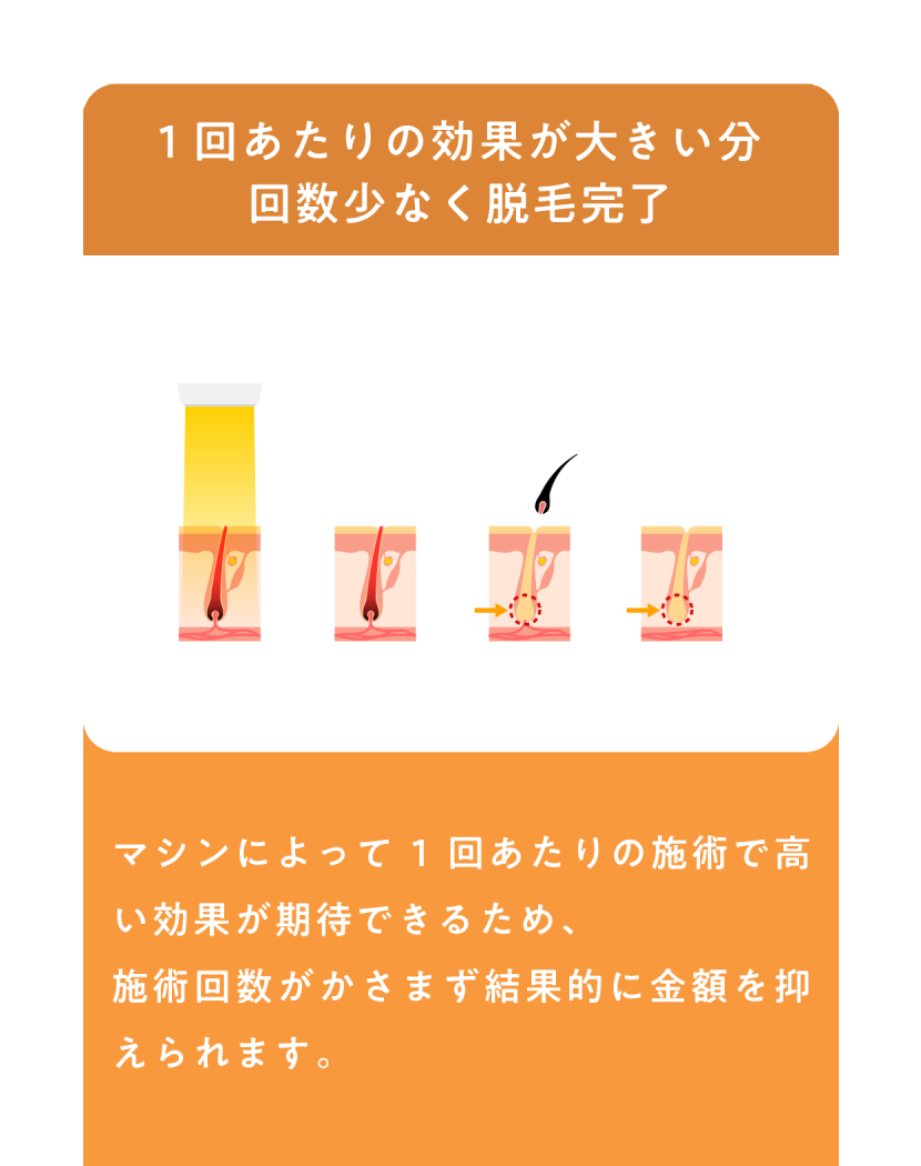 一回あたりの効果が大きい分回数少なく脱毛完了 マシンによって一回あたりの施術で高い効果が期待できるため、施術回数がかさまず結果的に金額を抑えられます。
